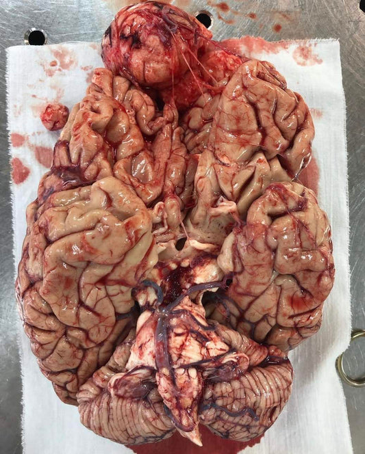 Hirnhauttumor